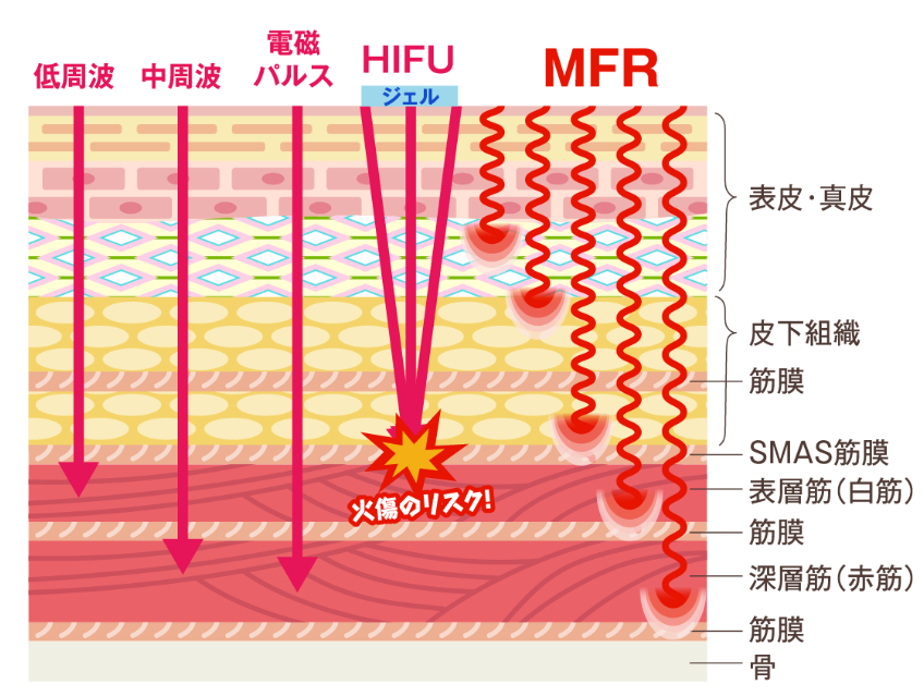 世界初の特殊波形、MFR搭載！